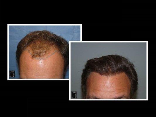 Dramatic results after a hair restoration surgery with Dr. Panine.