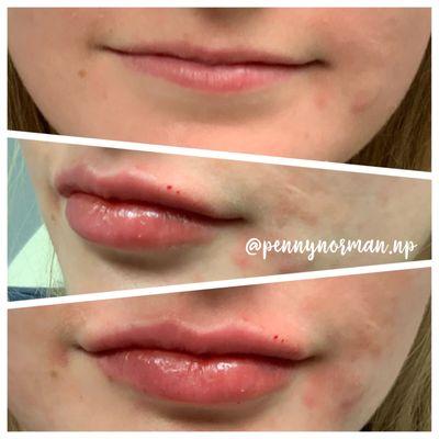 RESULTS MATTER. Lip Filler at its best!