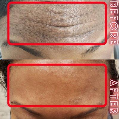 BOTOX can smooth out forehead wrinkles!