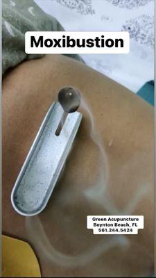 Moxibustion