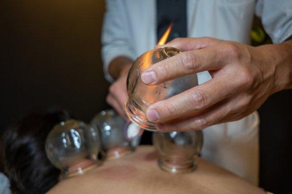 Cupping in action, promoting blood circulation to local muscles