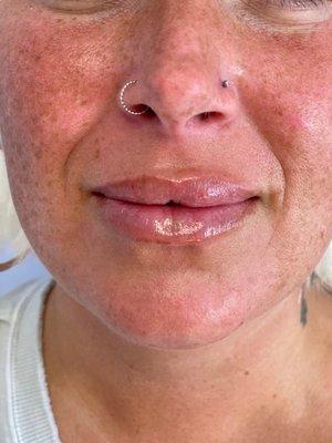 1 syringe lip filler