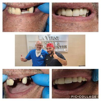 Placed and Restored 4 Upper Dental Implants. #HappyPatient #ImplantDentistry