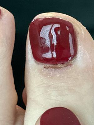 Pedicurist cut cuticle with electric dremel and then doused it with blue barbicide. This photo is 5 days after the injury.