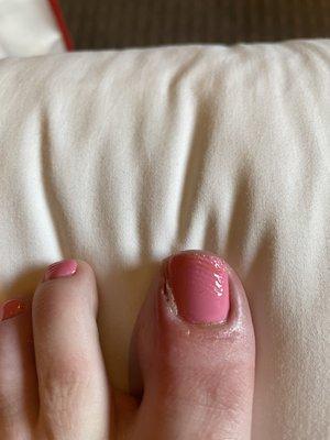 Indent in polish a day after pedicure and infection