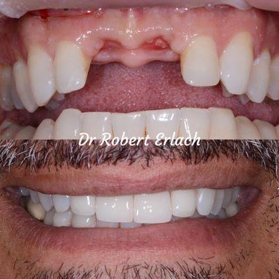 Our patient was in a bad accident and lost his front teeth. Dr Erlach was able to replace them with two implants and porcelain crowns.