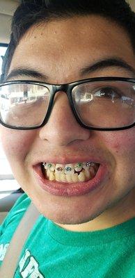 Braces