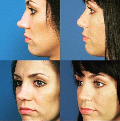 Rhinoplasty before and after