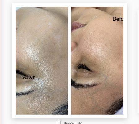 B/A Dermaplaning Treatment, One Facial