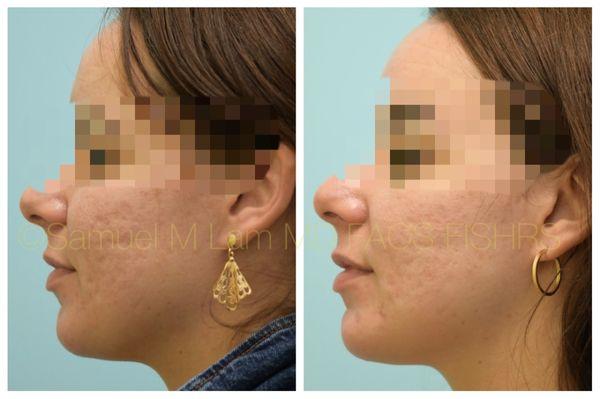 This 35-year-old patient of Dr. Lam had micro silicone droplets injected in three treatments to correct her acne scarring.