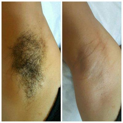 Before and after under arm wax...