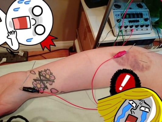 Needles carrying electrical current to my most painful areas. And yes, that's a lovely bruise...