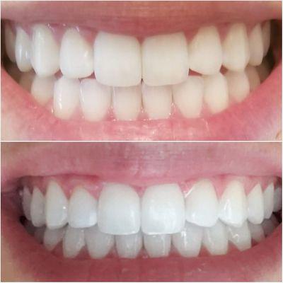 Teeth Whitening