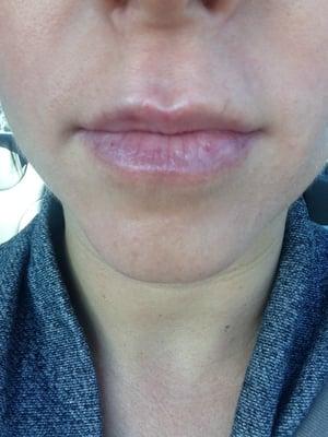 Received BELOTERO in my lips by Dr. Conrad, photo is from the next day. No bruising!