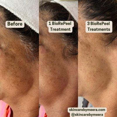 Before & After 3 BioRePeel Treatments