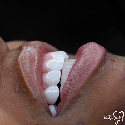 Porcelain veneers