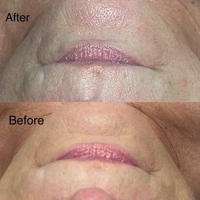 Before and after facial treatment you can see good results around chin area