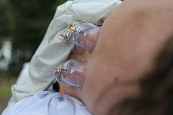 Cupping therapy