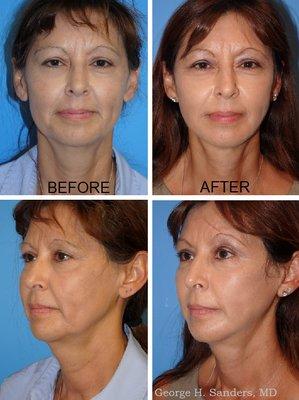 Facelift Patient is 53 Years Old.