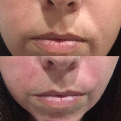 Before and after PRP filling of nasolabial folds.  Using the patient's own platelet rich plasma.