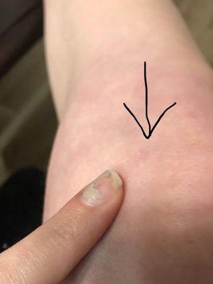 My non-existent scar 1 yr post op (meniscus repair)