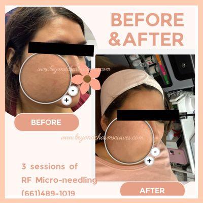 Micro-needling results