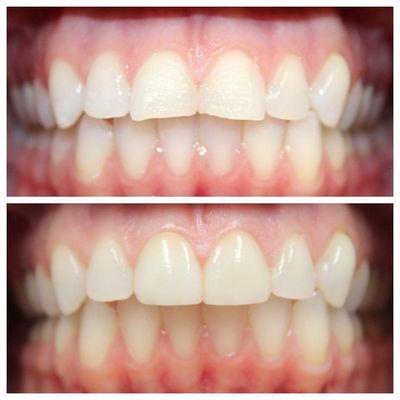 Helping patients achieve the smile they want and deserve is the best part of our job! Schedule yourself for a free veneer consultation today