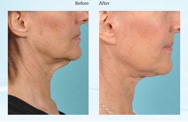 Facelift-Patient #15755 Frontal Before & After