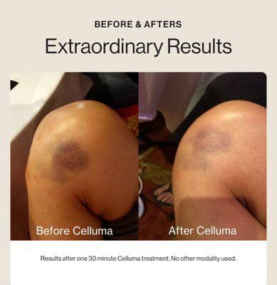 before/after Celluma