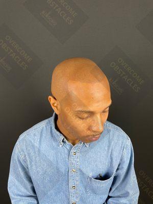 #1 Scalp Micropigmentation Dallas Texas