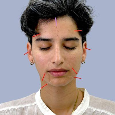 Facial acupuncture at A Plus Acupuncture & Massage Therapy located at 1300 Union Tpke #103A, in 
North New Hyde Park, NY.