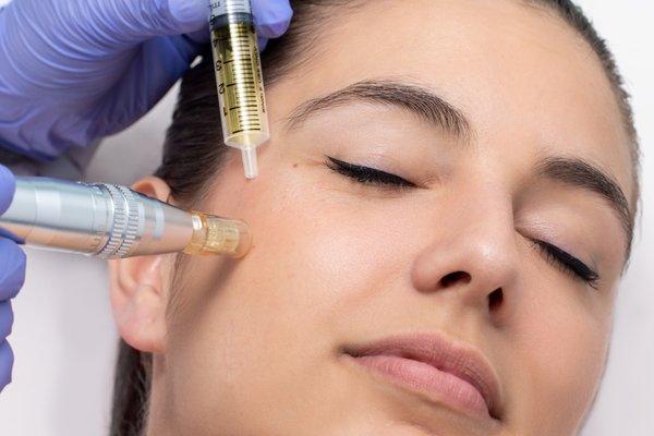 PRP is a great addition to microneedling treatments