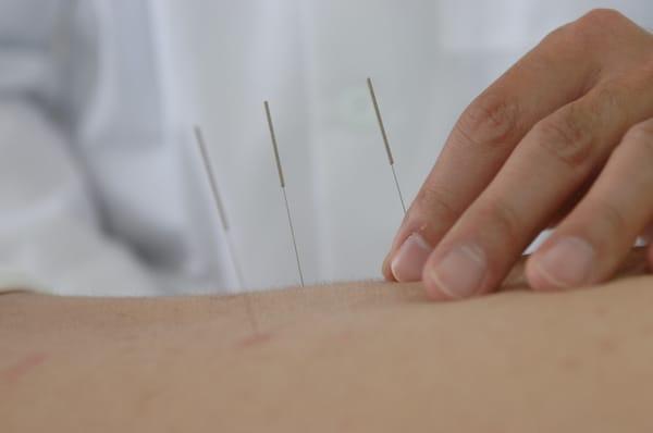 Acupuncture