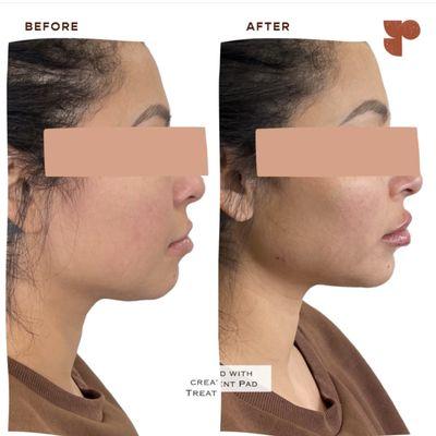 Facial balancing with lips, chin, jaw and midface dermal filler