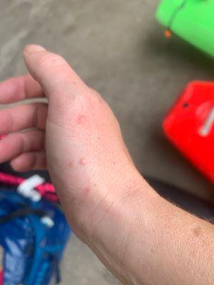 Bed bug bites