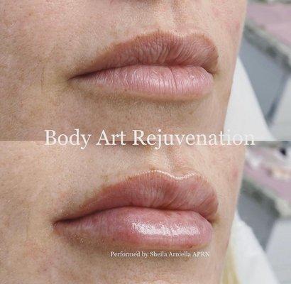 Lip filler injections.