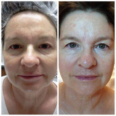 Before and after anti-aging skin rejuvenation microcurrent treatments