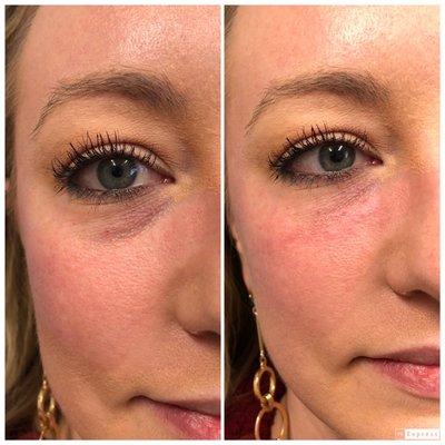 Before and after filler