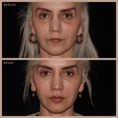 Lip Augmentation and Under Eyes with Hyaluronic Acid Filler