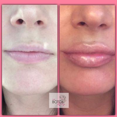 Patient selfie: Before & After lip filler