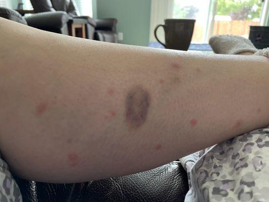 Ignore the bruise, look at all these bites!