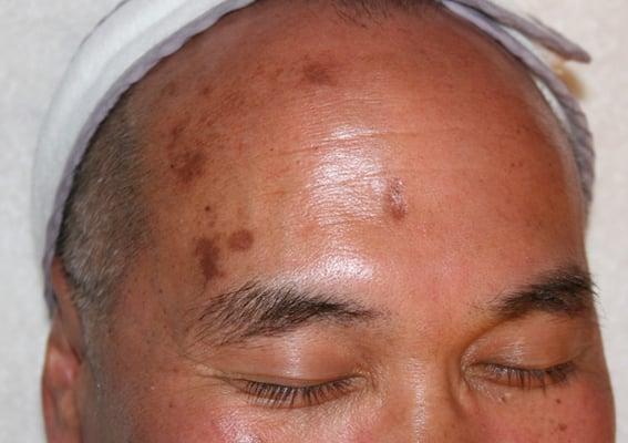 Hyper-pigmentation before treatment