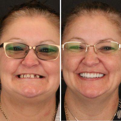 Final result of full mouth dental implants!