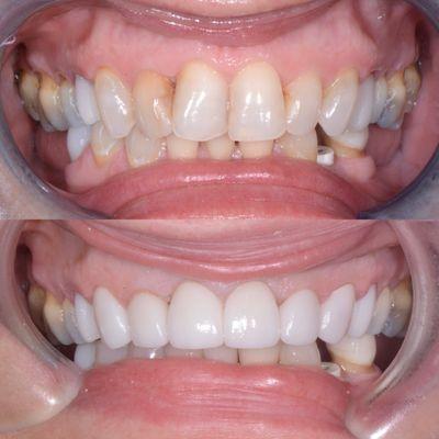 Anterior veneers