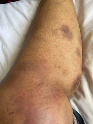 Leg Bruces after Mesotherapy