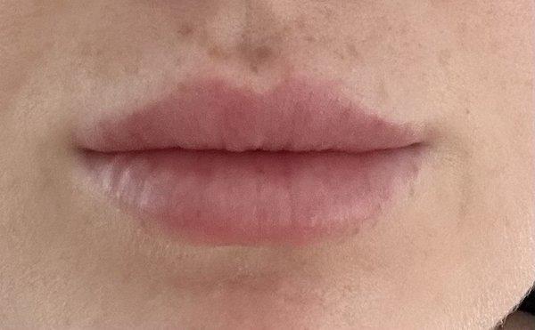 After lip filler with Dr. Satey.