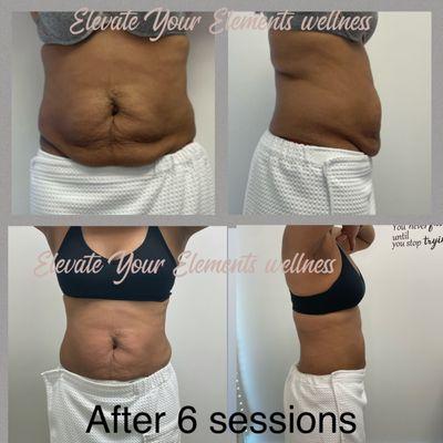 Body sculpting can help you get to your body goals. We offer tshock, cryoliposis, cavitation, radio frequency and laser Lipo.