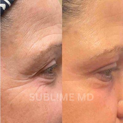 Soften fine lines/wrinkles with CO2 resurfacing around the eyes