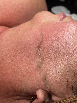 During Dermaplane (left is removal of vellus hair and right still has hair)