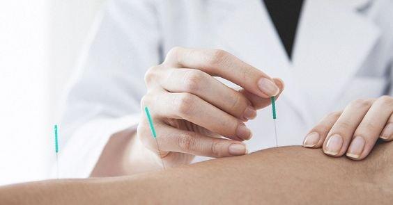 Dry Needling treatment for relaxing tense muscles, trigger points and to relieve pain.